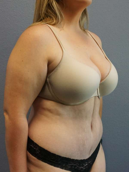 Abdominoplasty Before & After Patient #5197