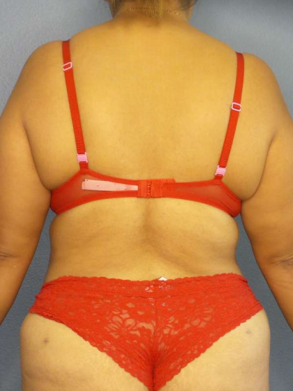 Abdominoplasty Before & After Patient #3638