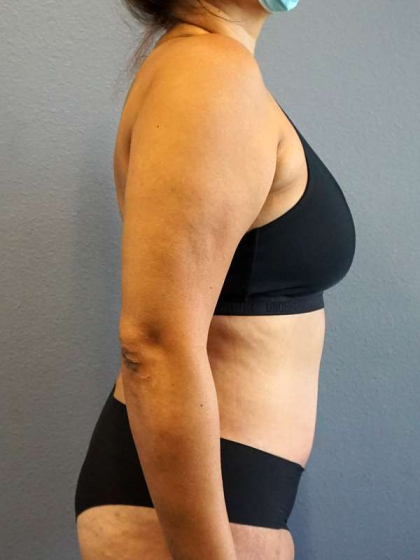 Abdominoplasty Before & After Patient #3583