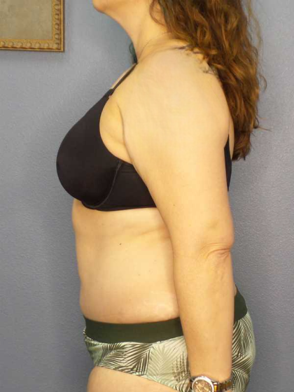 High BMI (Larger Patients) Surgery Before & After Patient #10272
