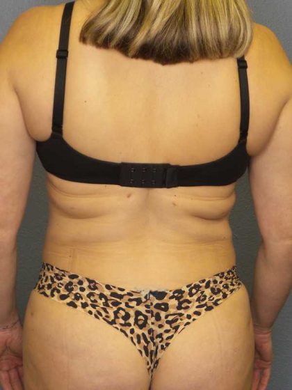 Liposuction Female Before & After Patient #7966