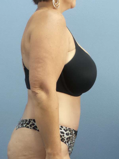 Abdominoplasty Before & After Patient #3786