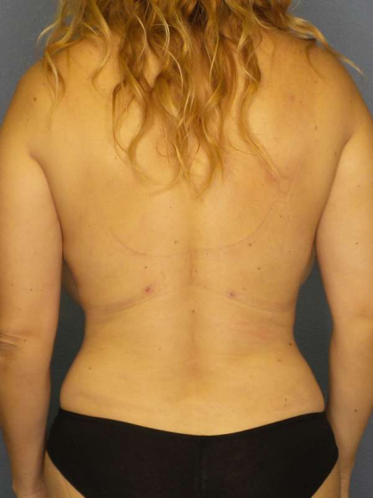 Liposuction Female Before & After Patient #8123