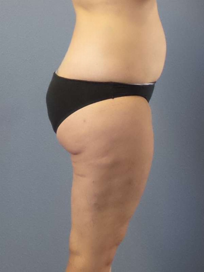 Liposuction Female Before & After Patient #7709