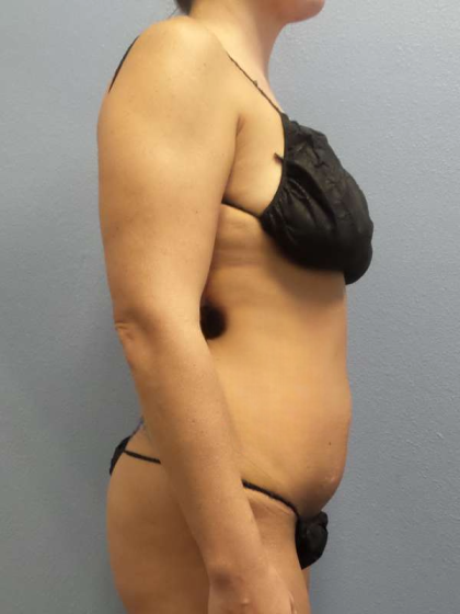 Abdominoplasty Before & After Patient #3775