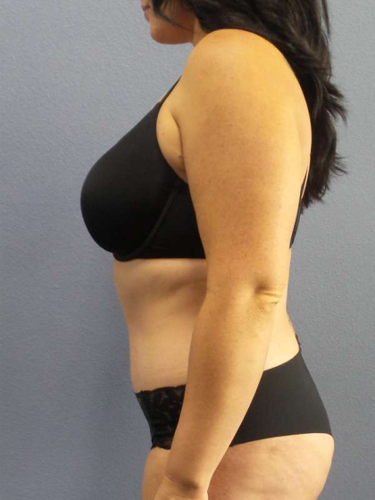 Abdominoplasty Before & After Patient #3550