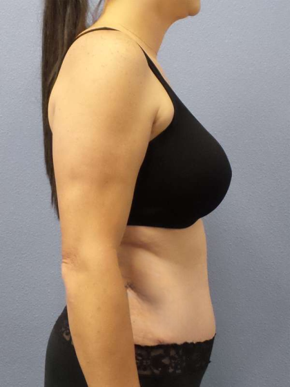 Abdominoplasty Before & After Patient #3471