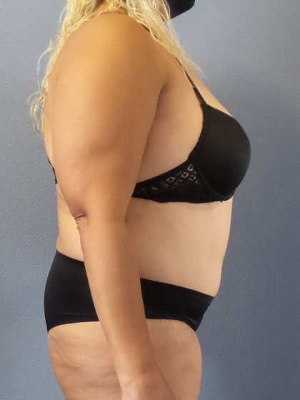 Abdominoplasty Before & After Patient #3437