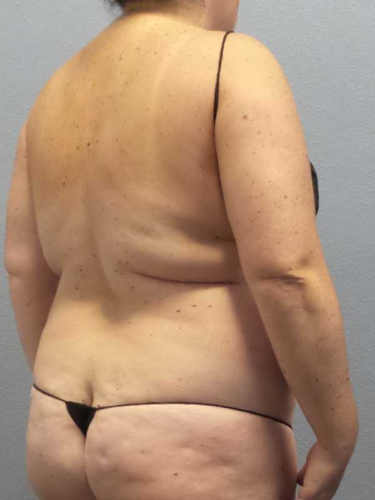 Liposuction Female Before & After Patient #11950