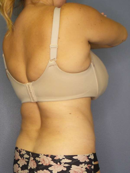 Liposuction Female Before & After Patient #8123