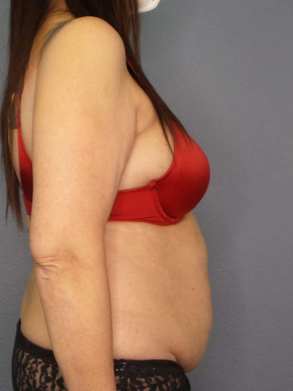 Liposuction Female Before & After Patient #7932