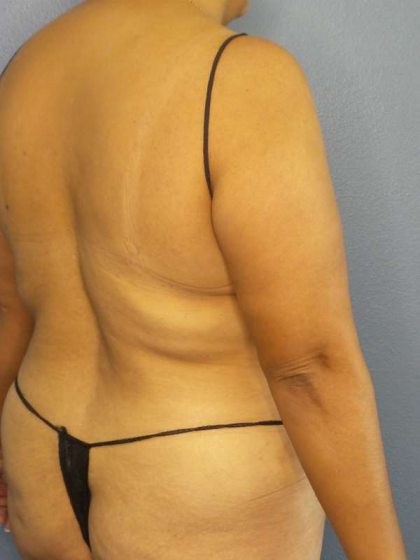 Abdominoplasty Before & After Patient #3638