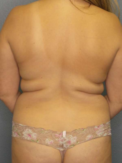 Liposuction Female Before & After Patient #7966