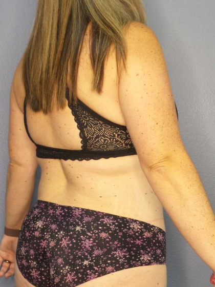 Liposuction Female Before & After Patient #11950