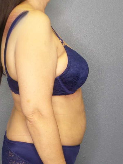 Liposuction Female Before & After Patient #7932