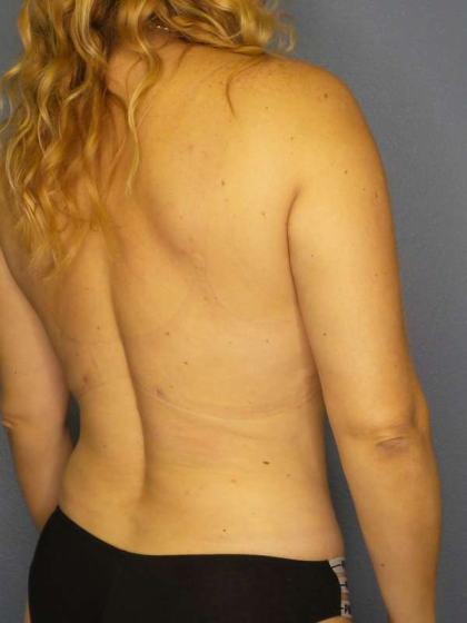 Liposuction Female Before & After Patient #8123