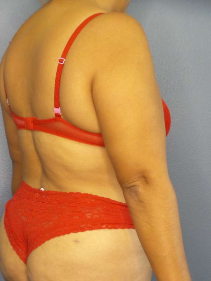 Abdominoplasty Before & After Patient #3638