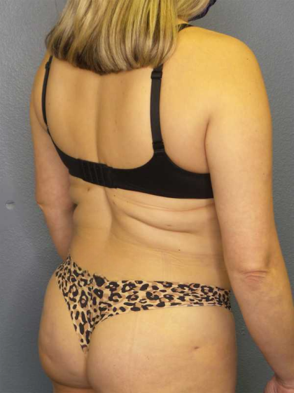 Liposuction Female Before & After Patient #7966