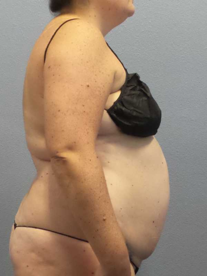 Liposuction Female Before & After Patient #11950