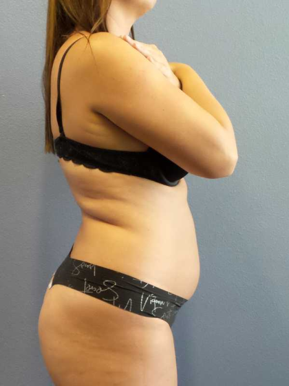 Liposuction Female Before & After Patient #11933