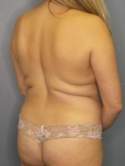 Liposuction Female Before & After Patient #7966
