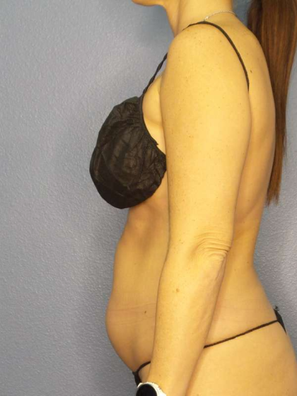 Liposuction Female Before & After Patient #8058