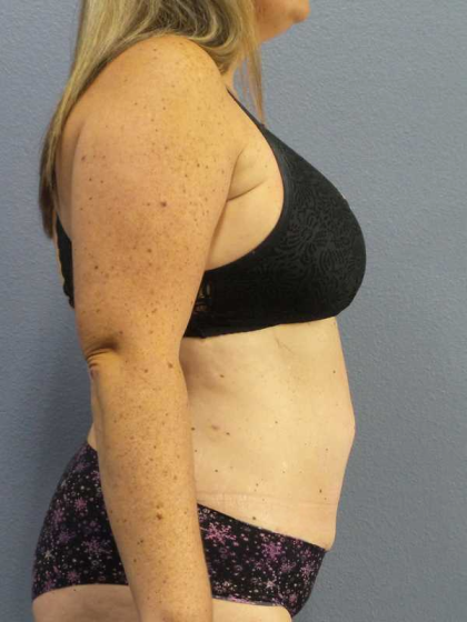 Liposuction Female Before & After Patient #11950