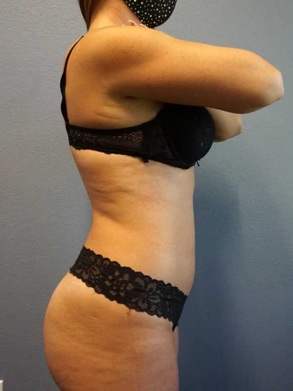 Liposuction Female Before & After Patient #11933