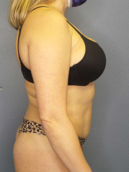 Liposuction Female Before & After Patient #7966