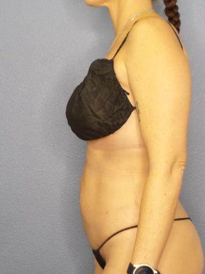 Liposuction Female Before & After Patient #8058