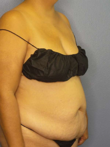 Abdominoplasty Before & After Patient #3638
