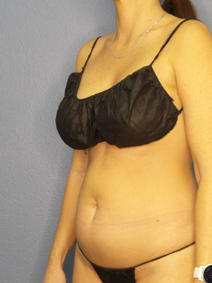 Liposuction Female Before & After Patient #8058