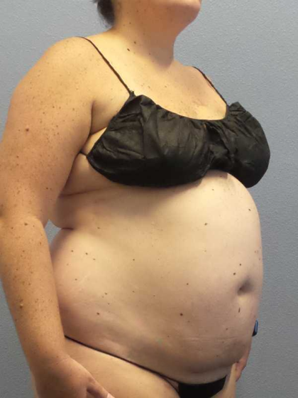 Liposuction Female Before & After Patient #11950