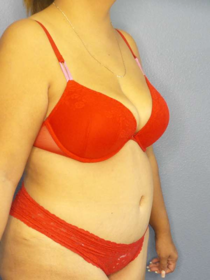 Abdominoplasty Before & After Patient #3638