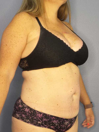 Liposuction Female Before & After Patient #11950