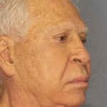 Facelift Before & After Patient #11809
