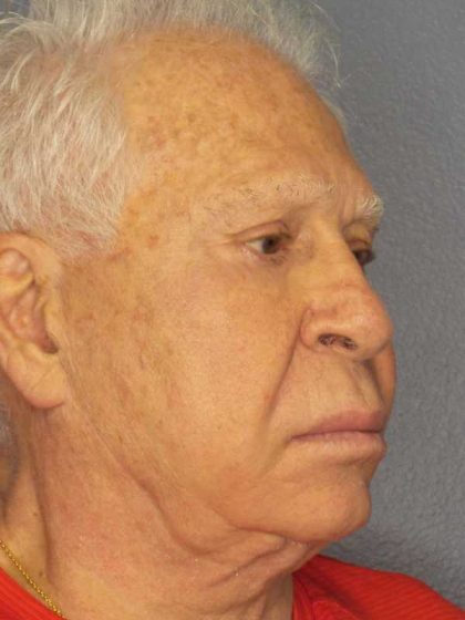 Facelift Before & After Patient #11809