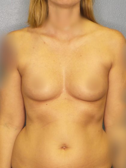 Breast Augmentation Before & After Patient #5312