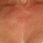 BroadBand Light (BBL™) Before & After Patient #13244