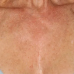 BroadBand Light (BBL™) Before & After Patient #13244