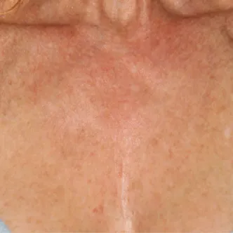 BroadBand Light (BBL&trade;) Before & After Patient #13244