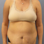 Abdominoplasty Before & After Patient #3594