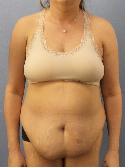 Abdominoplasty Before & After Patient #3594