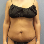 Abdominoplasty Before & After Patient #3775