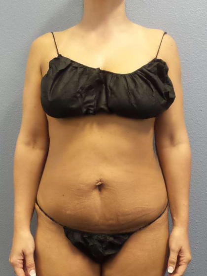 Abdominoplasty Before & After Patient #3775