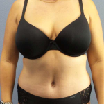 Abdominoplasty Before & After Patient #3550