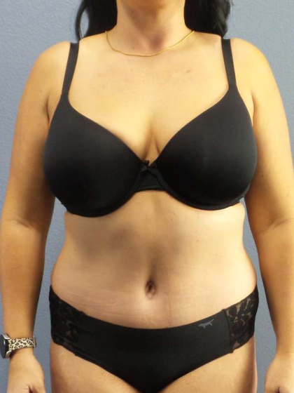 Abdominoplasty Before & After Patient #3550