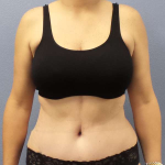 Abdominoplasty Before & After Patient #3471