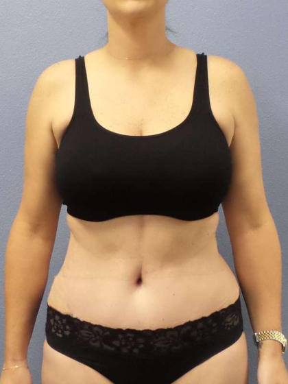 Abdominoplasty Before & After Patient #3471