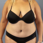 Abdominoplasty Before & After Patient #3437